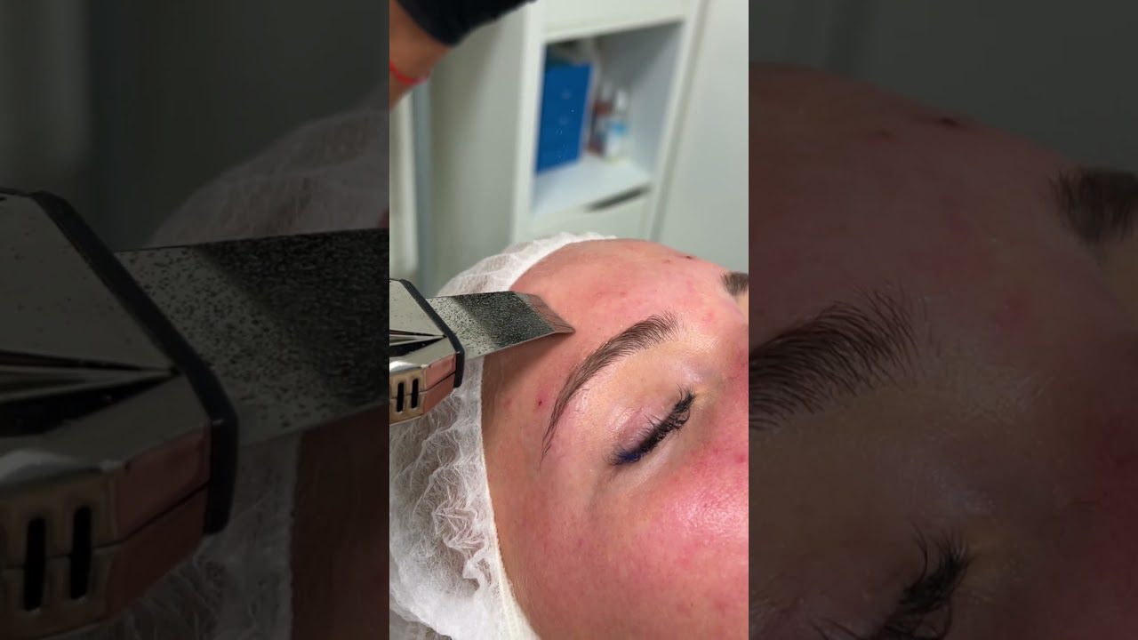 gili valymo veido procedūra