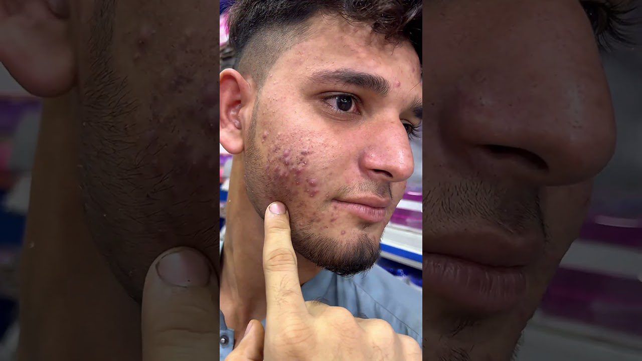 Švytinti ir švari spuogų serumas ir arbatmedžio veido prausiklis Nuostabūs #ameenbeautytips