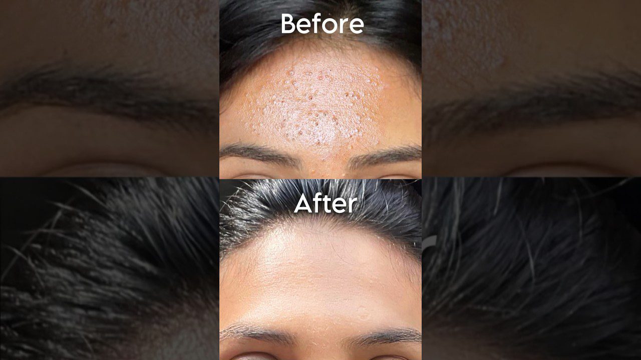 Kaip atsikratyti smulkių iškilimų per 30 dienų✨ #Trumpai #sristydutta #skaidriodė #acne #smulkūsįkilimai #stiklinėoda