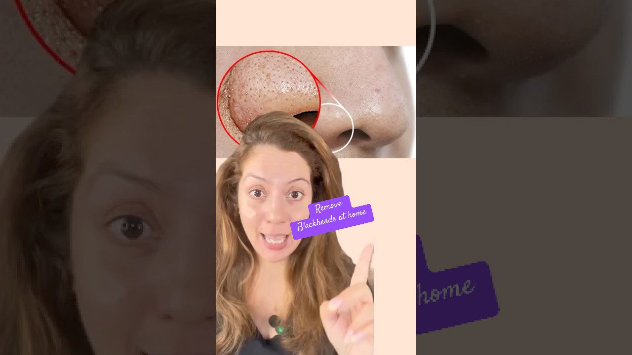 Moteris rodo pirštu, viršuje arti nosies vaizdas su juodais taškais ir užrašu „Remove Blackheads at home“ (pašalinti inkštirus namuose)