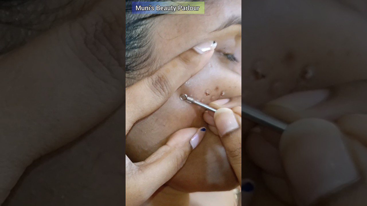 Veido spuogų spaudymas kosmetiniu įrankiu, matomi išspausti inkštirai ir rankos.