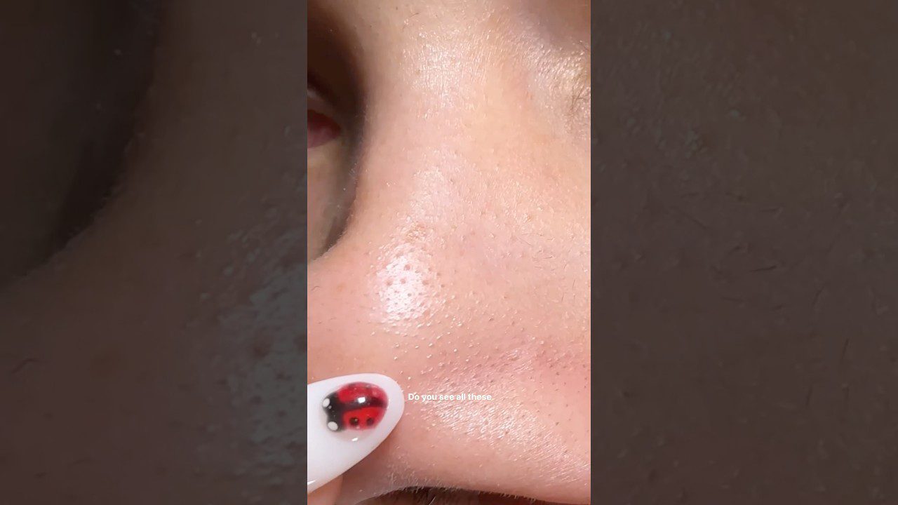 Veido šonas su matomomis išsiplėtusiomis poromis ir nagų dažais su boružės piešiniu