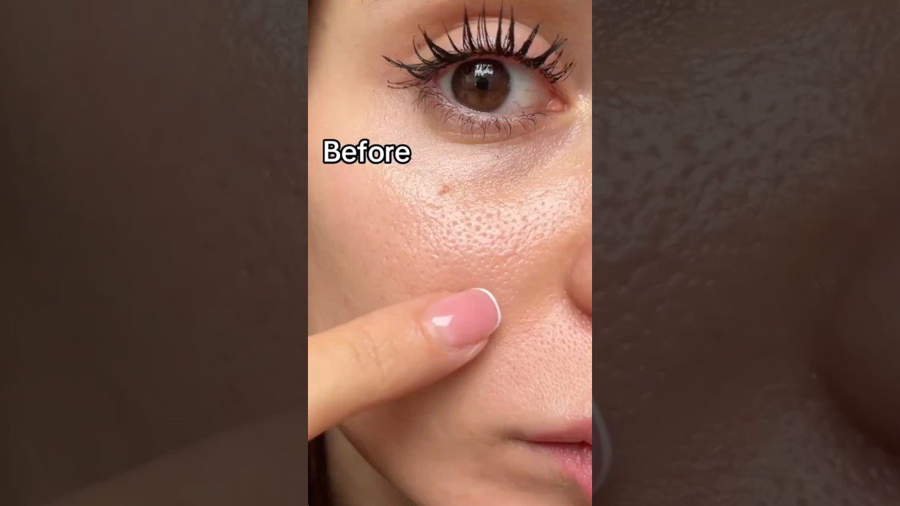 Moteris rodo didelius veido poras ant skruosto, viršuje užrašas „Before“ (prieš).