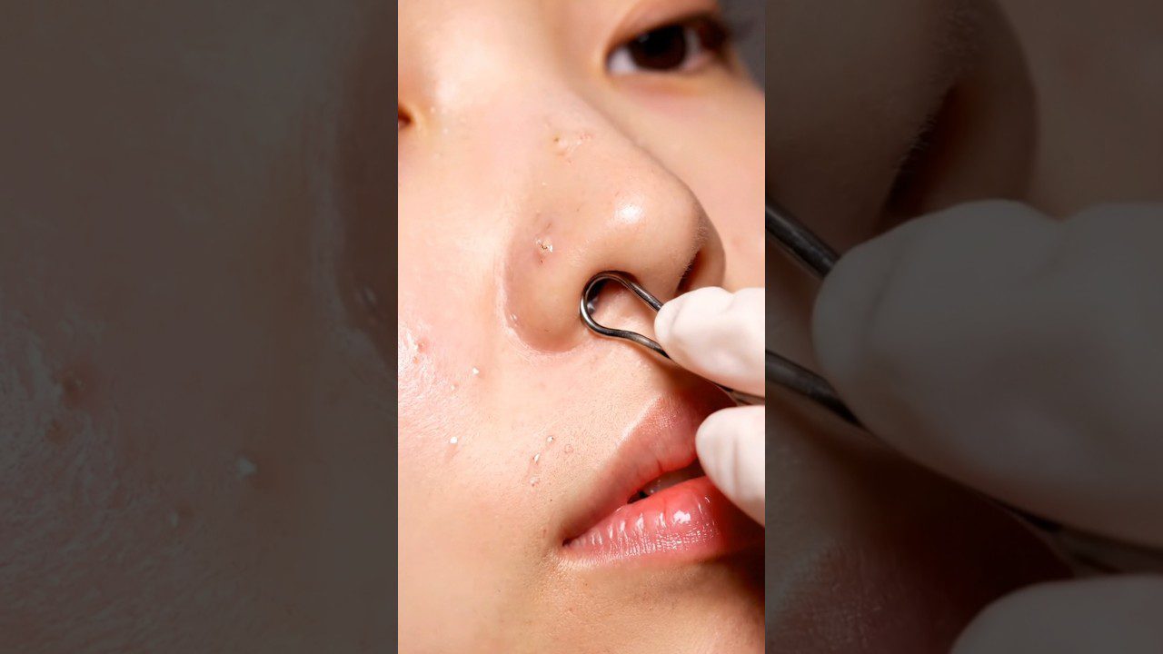 Rankios nosies odos išspaudimo įrankiu valomas komedonas spuogas.