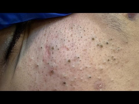ASMR Gili Valymo Procedūra Be Akne – Spuogų Spaudimo ir Juodųjų Taškų Šalinimo Technikos