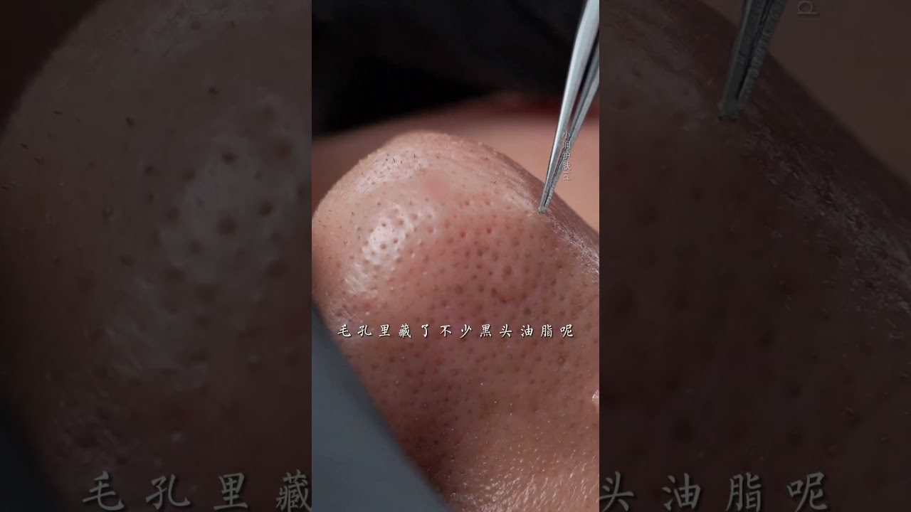 Šiandien turiu didelį valymą#įtraukiančios odos priežiūros#juodosios dėmės#braškių nosis#dideli poros#oda