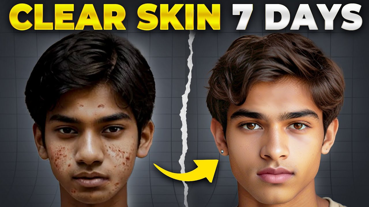 Jaunuolio veido prieš ir po odos valymo, kairėje spuogai, dešinėje švari oda.