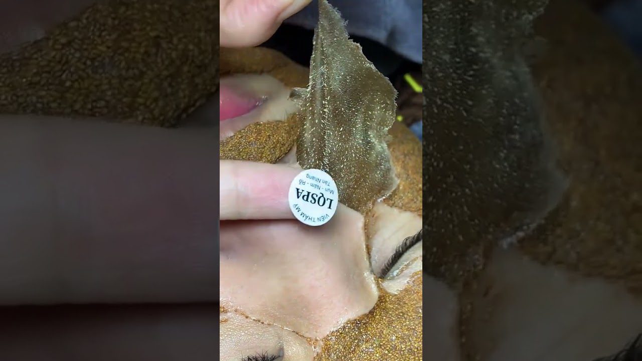 Veidas padengtas rudu, blizgiu šveičiamuoju kauke; estetinė specialistė nuima plėvelę.