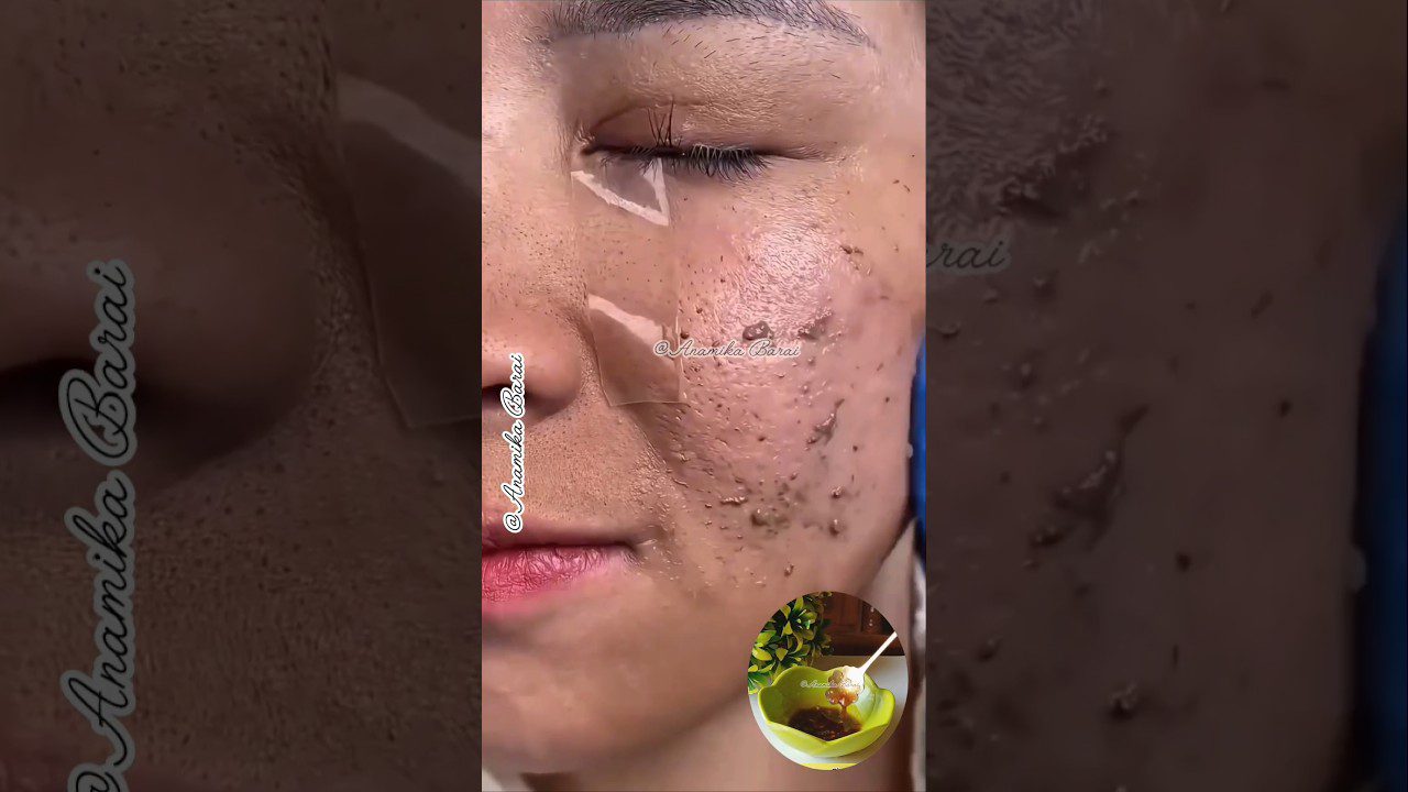 Moteris su akne ir išspaustomis komedonų granulėmis ant skruosto, užrištas skruosto plotas.