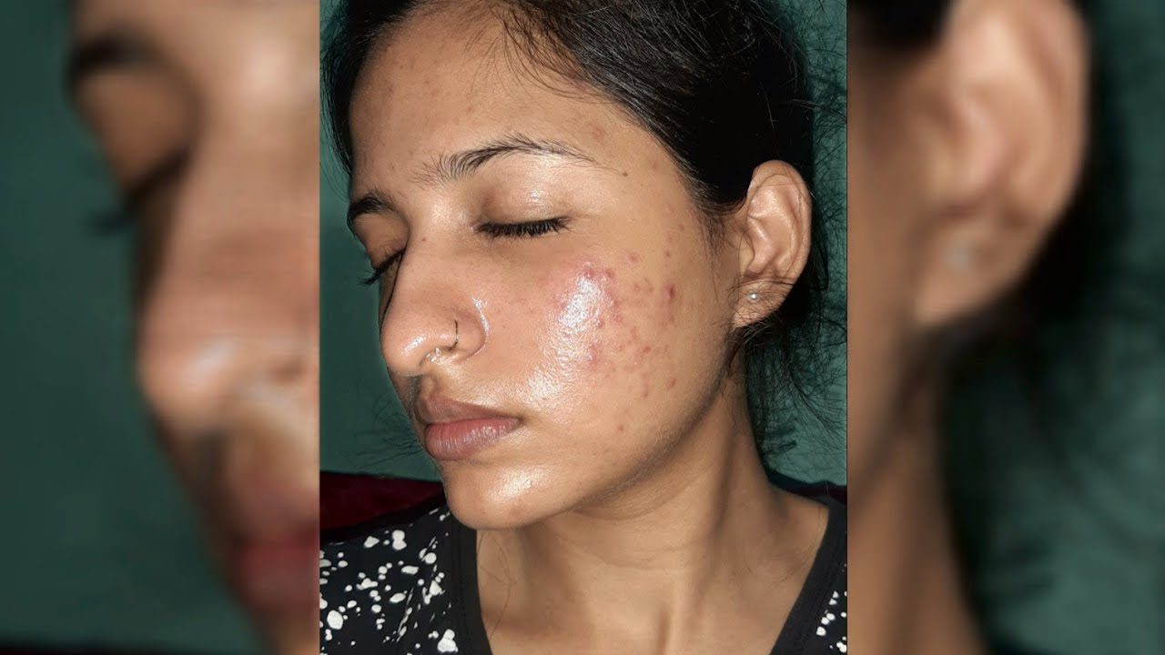 jaunos moters kairės skruosto aknės žymės ir raudoni uždegiminiai spuogai, užmerktos akys