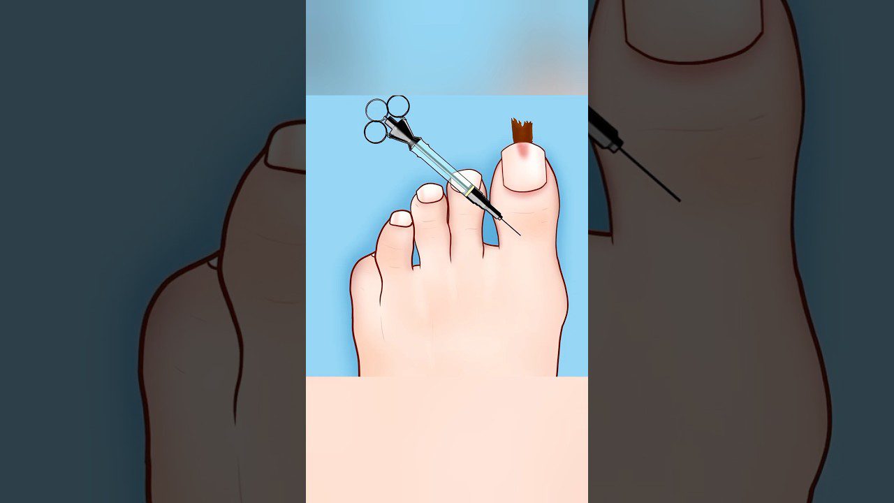 Didelis piršto nagas su užaugusia oda ir šalia adata bei žirklėmis dezinfekcijai ir gydymui