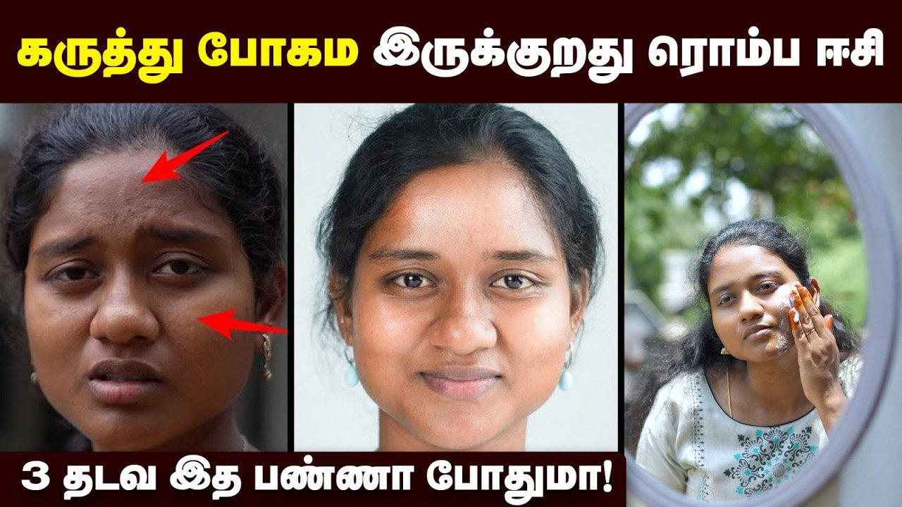 jaunos moters veidas prieš ir po odos valymo, rodomi spuogai ir teptukas veidui, tekstas tamilų kalba viršuje ir apačioje