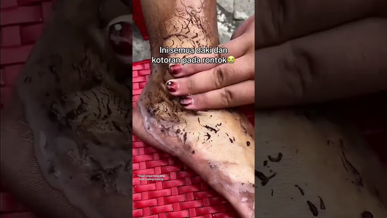 Rankomis trinama kojų oda su juodu šveitikliu, išsiskiria sausos odos gabalėliai