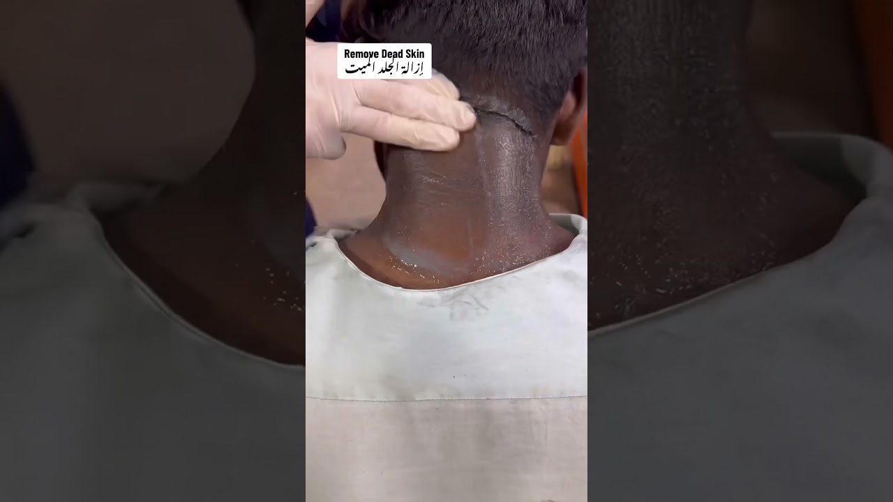 Specialistas su pirštine švelniai lupinėja negyvą odą nuo kaklo nugaros dalies.