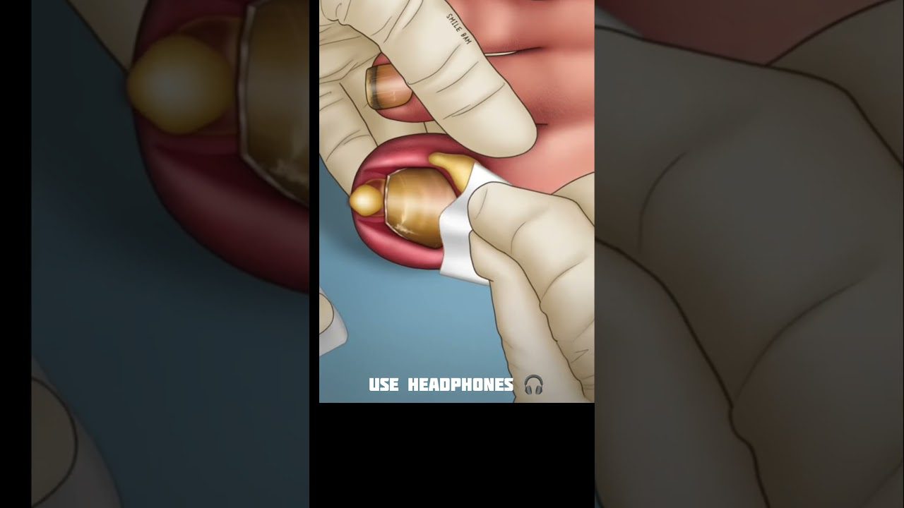 Glovėtomis rankomis valomas ausies kanalas su ausies vaško kaupele ir užrašu „use headphones“