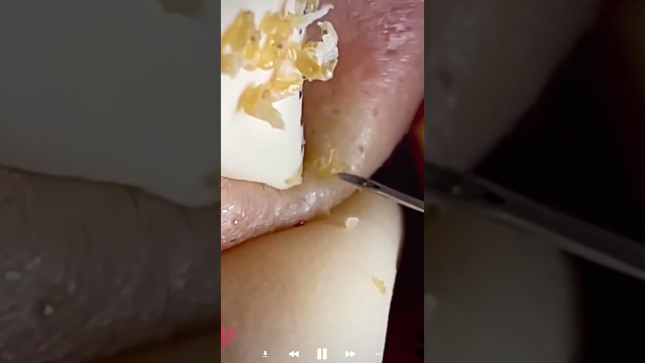 artimųjų spenelio išspaudimas skalpeliu, riebalinės masės gabalėliai ant odos