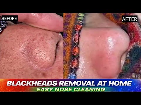 Priekinis nosies paviršius prieš ir po juodgalvių valymo, matomi švarūs porų rezultatai