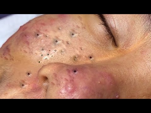 Veido oda su daugybinėmis užsikimšusiomis poromis, spuogų randais ir uždegimu.
