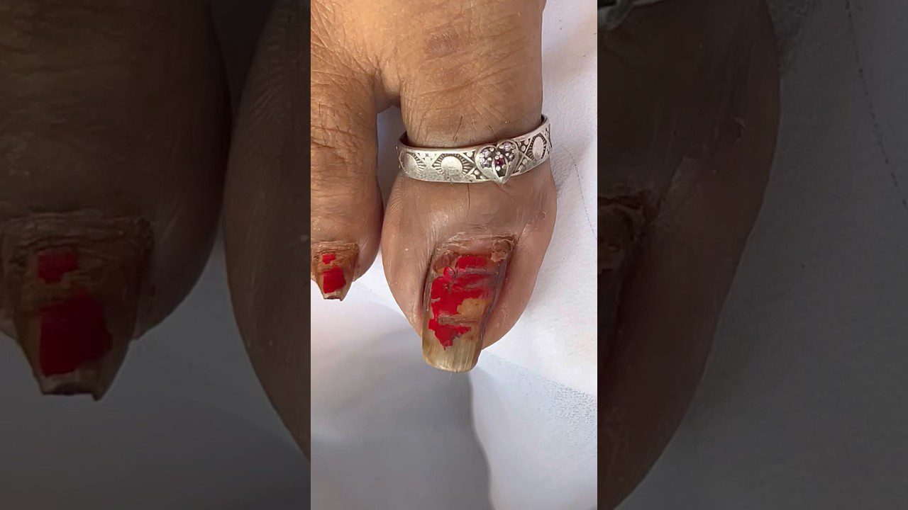 Didelis piršto nagas su nusitrynusiu raudonu laku ir sidabriniu piršto žiedu.