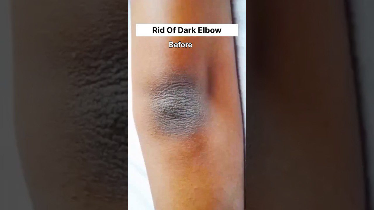 Tamsus, šiurkštus alkūnės odos plotas su užrašu „Rid Of Dark Elbow“ ir „Before“