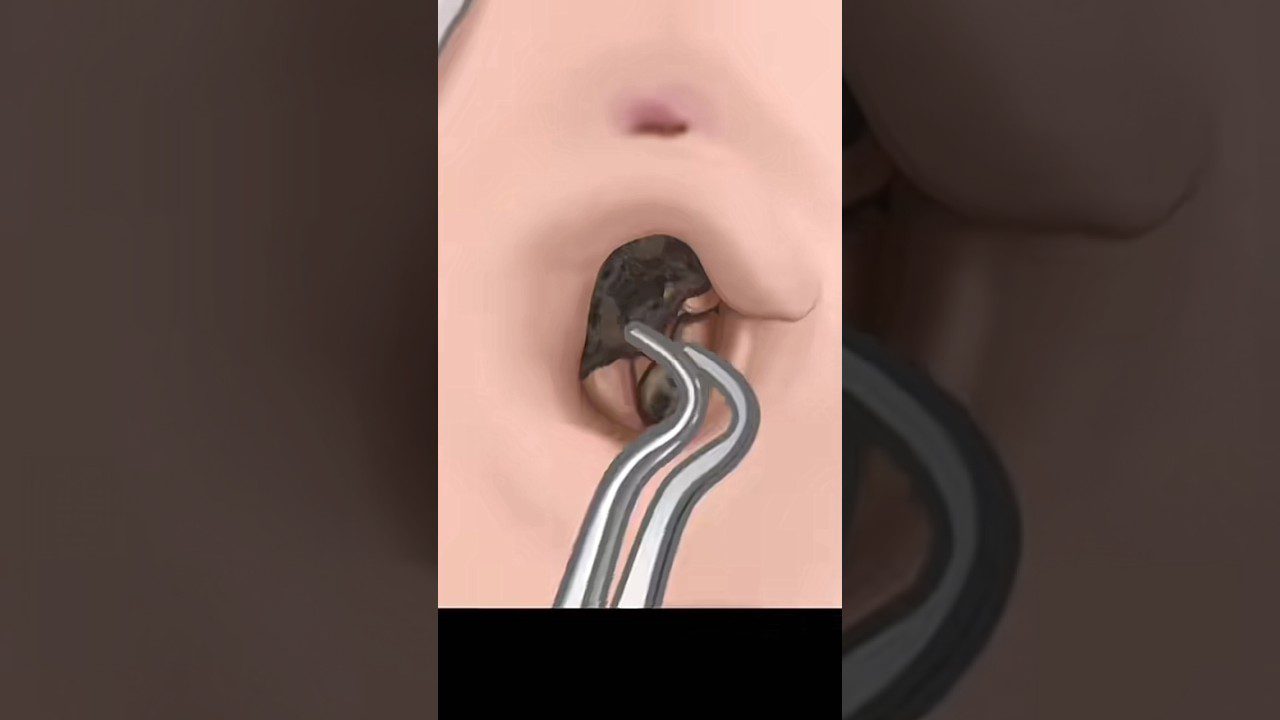 Ausies landelėje įsikibusi ir šalinama tamsi sieros kamštis pincetais