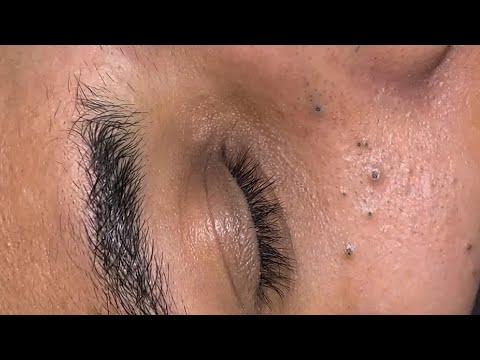 Uždaryta akis su blakstiena, ant skruosto keli inkštirai ir pora juodų taškelių