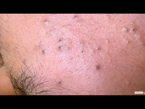 Veidas su užkrėstomis poromis ir matomais juodais inkštais bei uždegimais