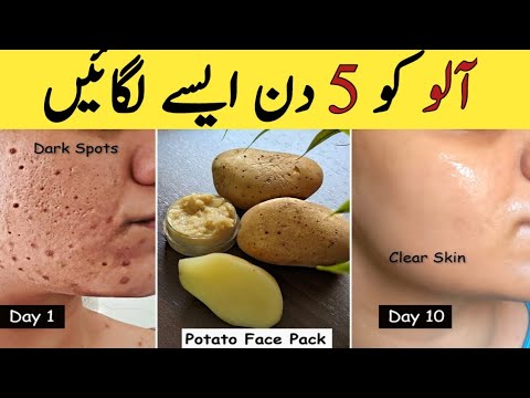 Priekinis veido kadras su tamsiomis dėmėmis, bulvių veido kaukė ir aiškesnė oda po 10 dienų