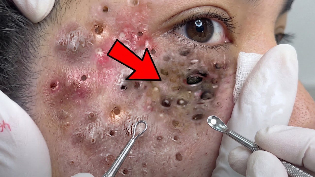 Veide daug išspaustų ir atvirų porų su gydytojo rankomis ir instrumentais.