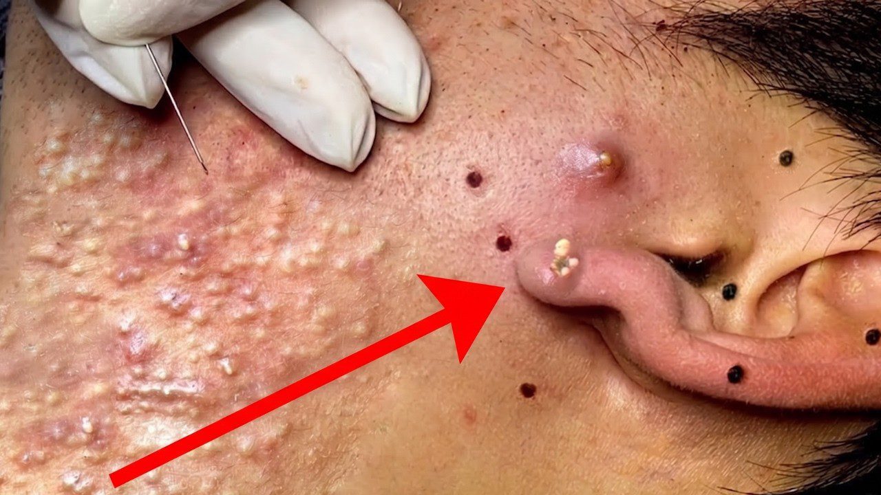 Veido šonas su daug inkštirų ir priemėgų išspaudimo procedūra šalia ausies