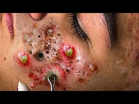 Veido oda su daugybe uždegiminių spuogų, pūlių išsiskyrimo ir juodų komedonų.