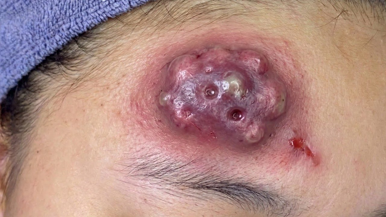 Veido kairiajame kaktos srityje didelis raudonas uždegiminis spuogas su keliais pūlinukais