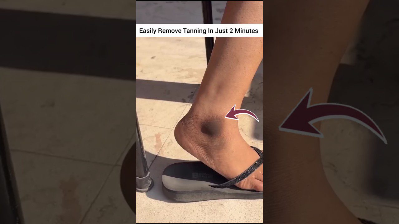 kulno sritis su tamsesne įdegio dėme ant kulkšnies, rodyklė nurodo dėmę