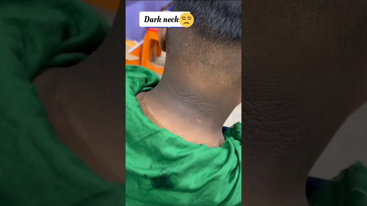 vaiko kaklo nugarinė dalis su tamsesnėmis pigmentuotomis ir šerpetojančiomis odos vietomis