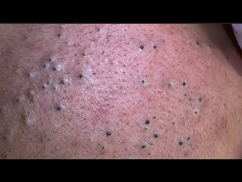 Krutinės odos plotas su daug atvirų komedonų (juodų inkštirų) ir plauko folikulų