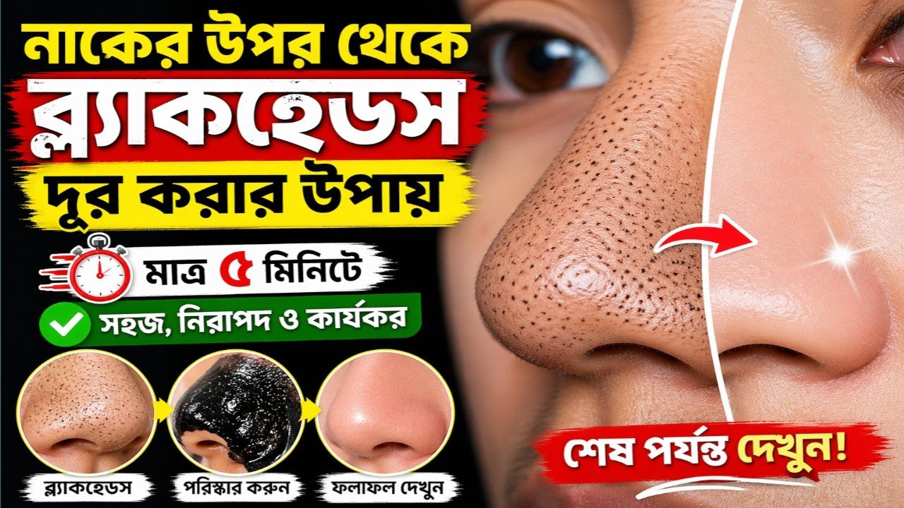 Nosies juodų porų valymas prieš ir po, rodomas pašalintas inkštirus ir lygi oda.