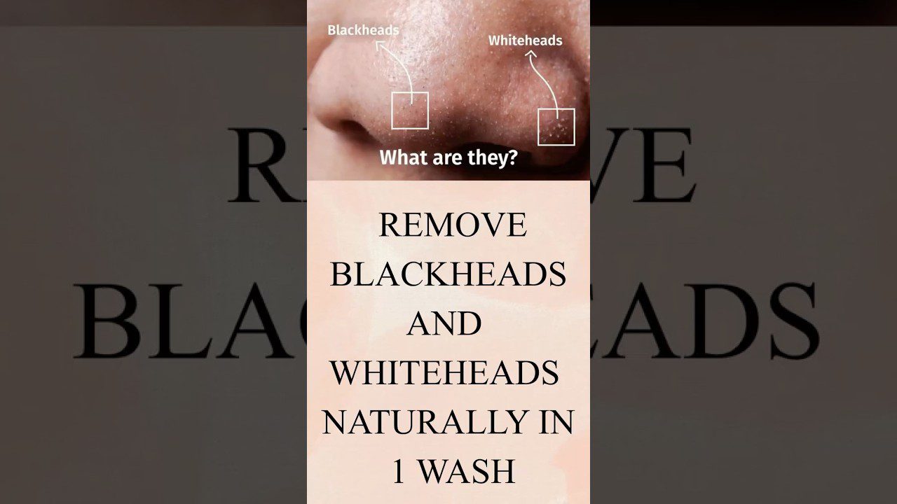 Veidas su užkimštomis poromis, rodomi juodi taškai (komedonai) ir balti spuogeliai, bei tekstas apie jų šalinimą