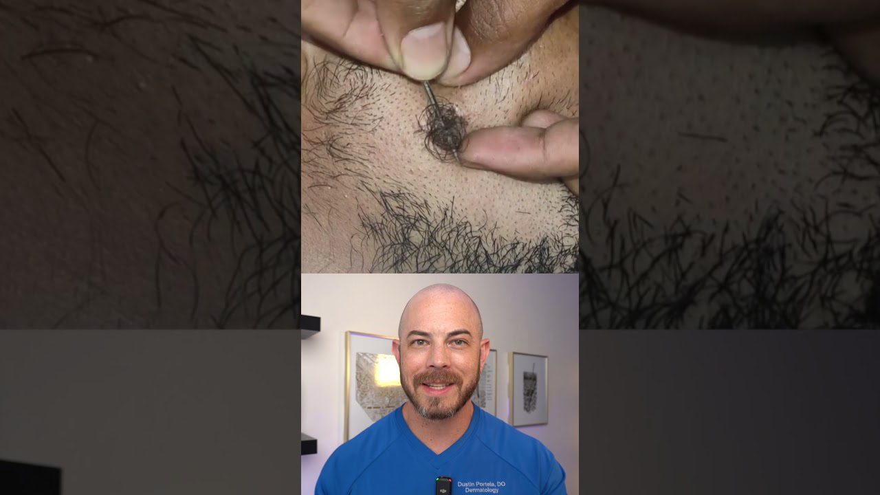 Rankomis ištraukiamas įaugęs plaukas virš vyrų smakro, apačioje dermatologas šypsosi.