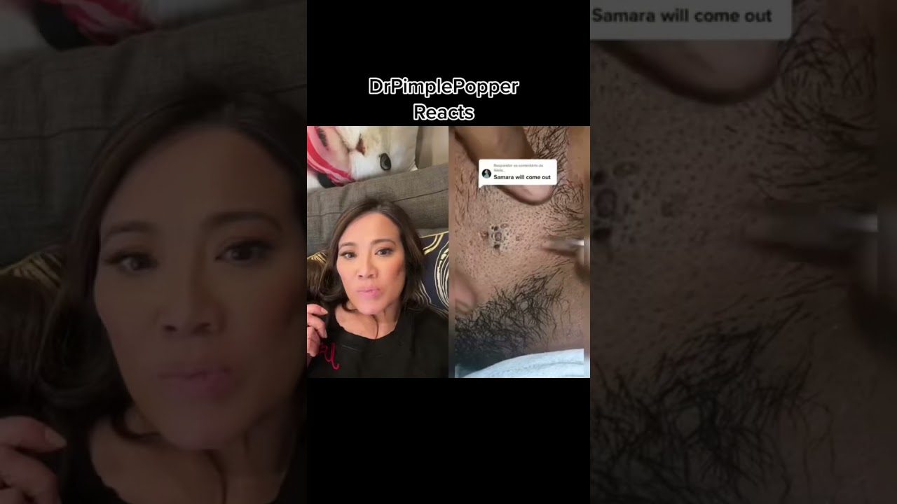 Moters veidas kairėje ir dermatologo reakcija prie spuogo ekstrakcijos dešinėje, užrašas „Samara will come out“.