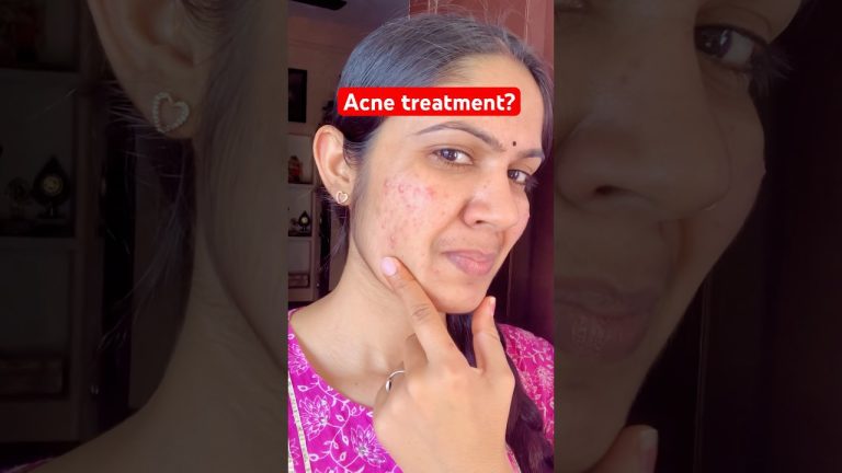 Moteris rodo spuogų pažeistą skruostą ir pirštu liečia žandikaulio sritį, užrašas „Acne treatment?“