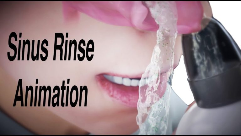 Vaizdas: asmuo plauna nosies ertmes srovėmis, šalia užrašas „Sinus Rinse Animation“
