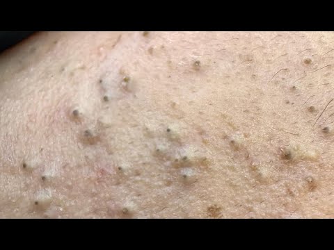 Veido kaklo odos uždegiminiai spuogeliai ir užsikimšusios poros, artimas planas
