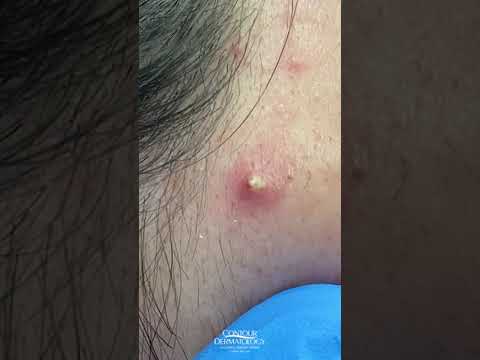 Veido šonkaulyje paraudęs spuogas su baltu pūlio kamščiu ir aplinkiniu uždegimu