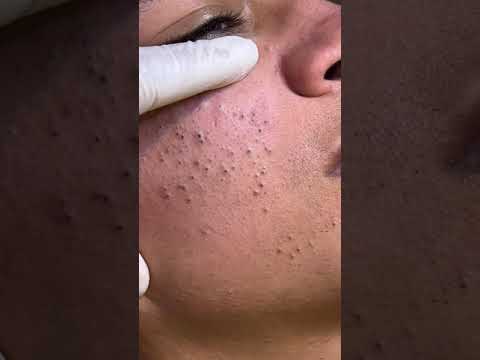 Veidas su užsikimšusiomis poromis ir spuogų randais, estetiko pirštas liečia skruostą