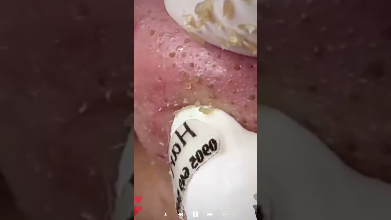 Veidas su išspaustomis inkštirais priešais estetinės procedūros įrankį