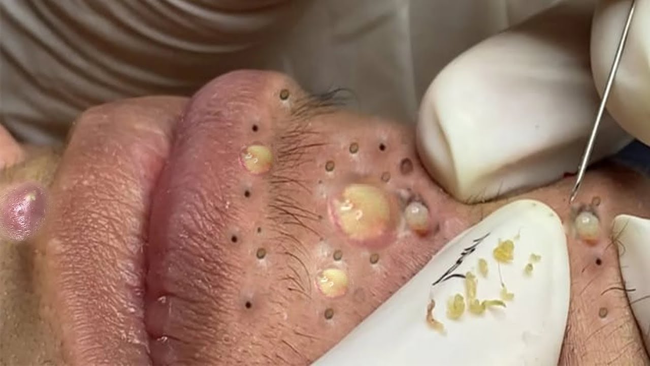 Ant lūpos matomi išspausti inkštirai ir pūlinukai, gydytojas juos šalinąs.